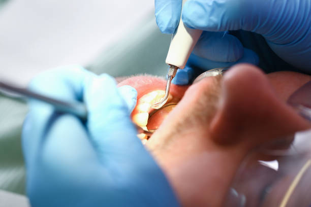 Best Chipped Tooth Repair Near Me  in Graceville, FL